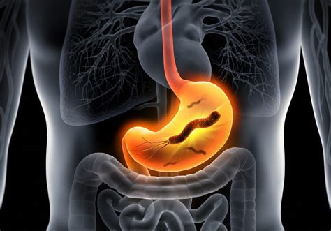Helicobacter pylori (H. pylori) infection .